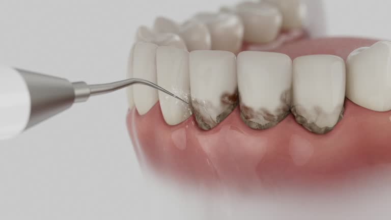 Trusted Wisdom Tooth Removal service in Dranesville, VA - Dentist Open Now